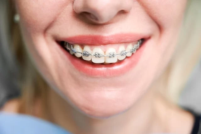 Aparat dentar