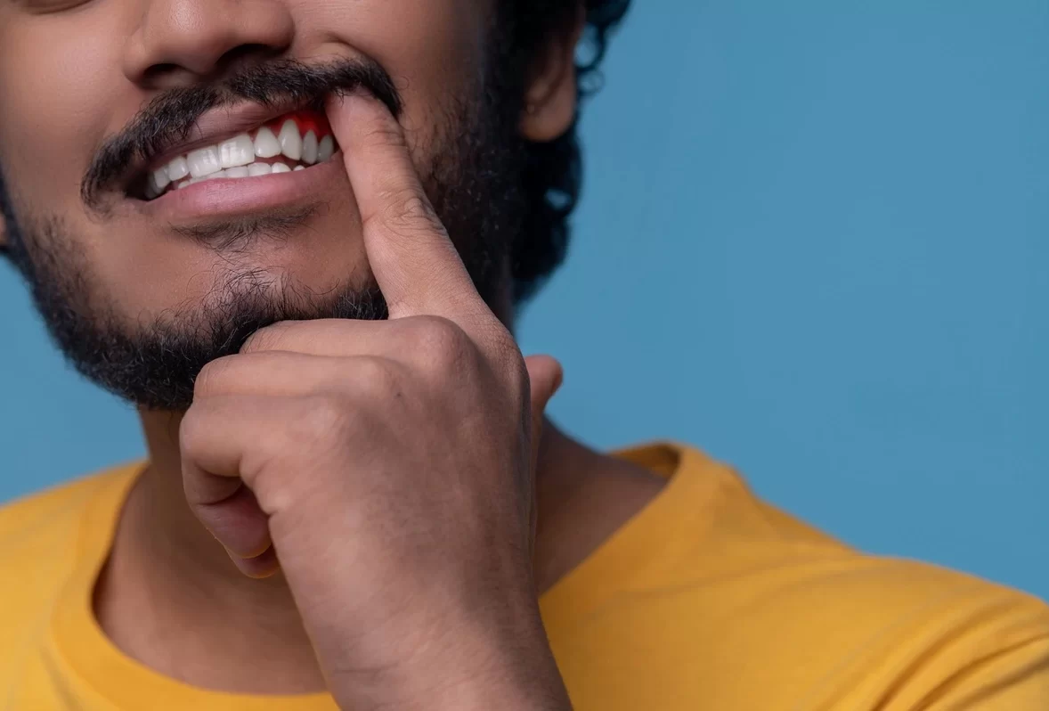 Gingii inflamate: ce înseamnă și de ce apar?