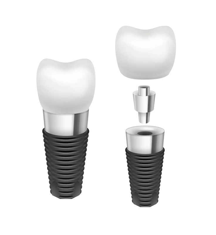 implant dentar straumann la medical hub https://medical-hub.ro/wp-content/uploads/2026/06/implant-dentar-straumann-la-medical-hub.webp